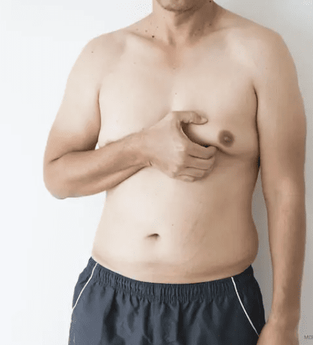 Gynecomastia gallery1