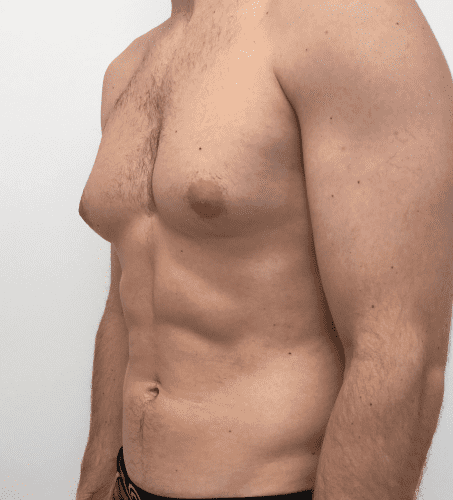 Gynecomastia gallery4