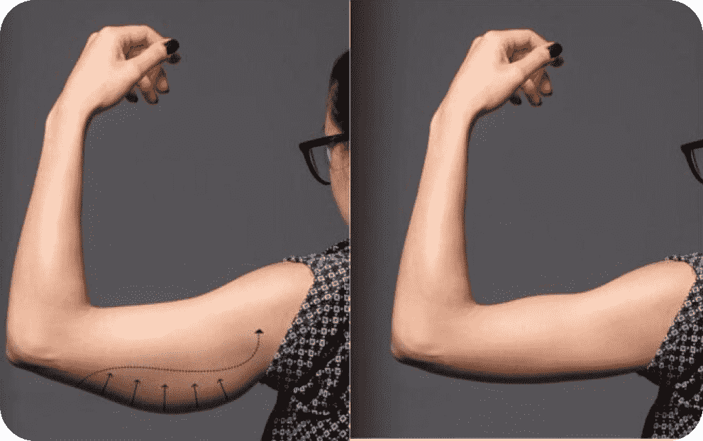 عمل لیپوساکشن الو جراح