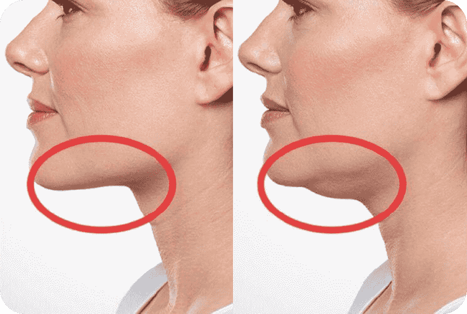 لیپوساکشن غبغب در الو جراح