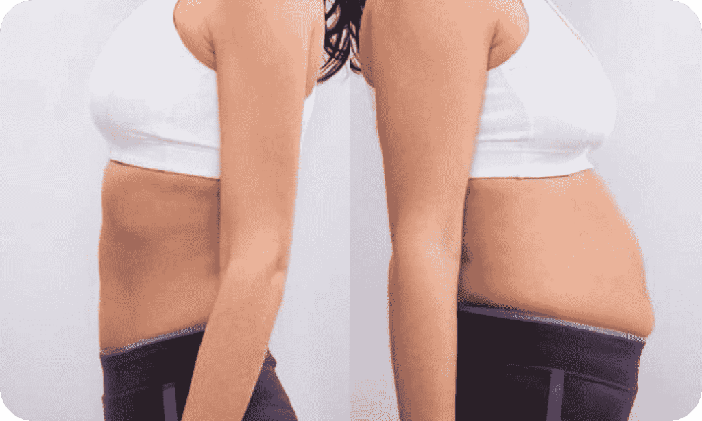 لیپوساکشن شکم در الو جراح