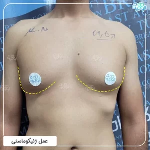 درمان ژنیکوماستی با جراحی 12