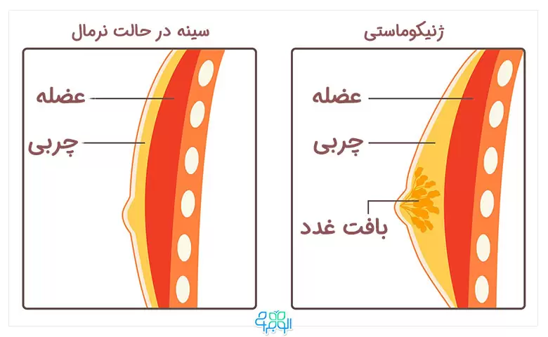 بازگشت ژنیکوماستی بعد از عمل