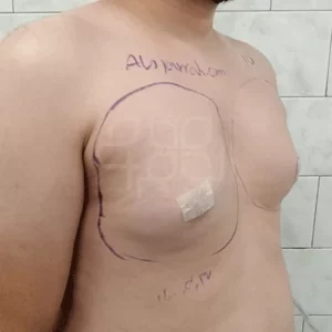 تجربه جراحی ژنیکوماستی در مجموعه الوجراح