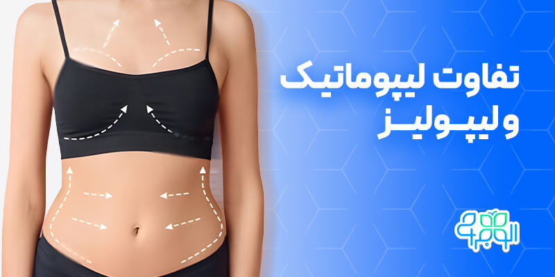 تفاوت لیپوماتیک و لیپولیز