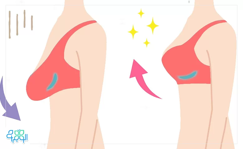 دلایل افتادگی سینه‌ها در بانوان