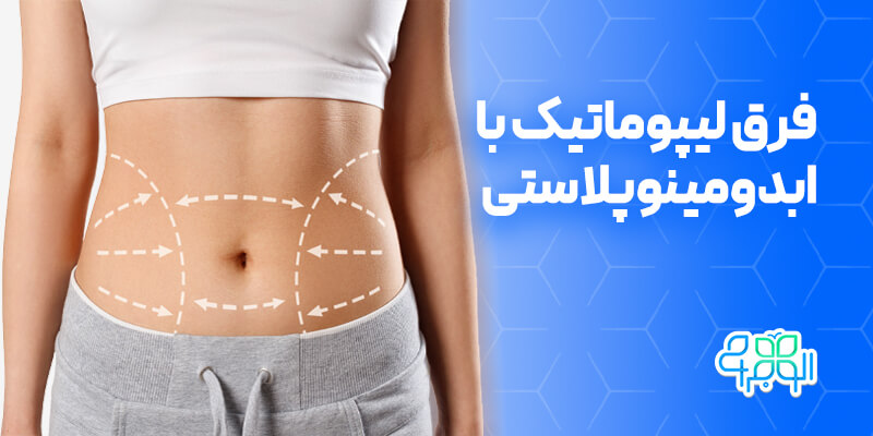 فرق لیپوماتیک با ابدومینوپلاستی