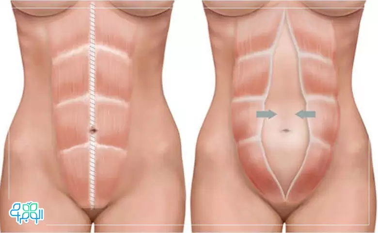 فرق لیپوماتیک با ابدومینوپلاستی چیست