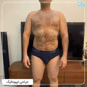 عمل جراحی لیپوماتیک شکم آقایان