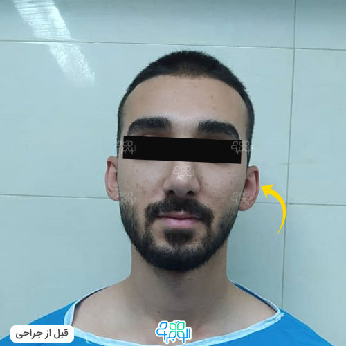 عکس قبل عمل زیبایی گوش آقایان