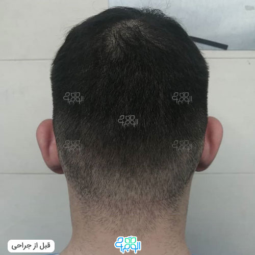 عکس قبل عمل گوش برجسته 2