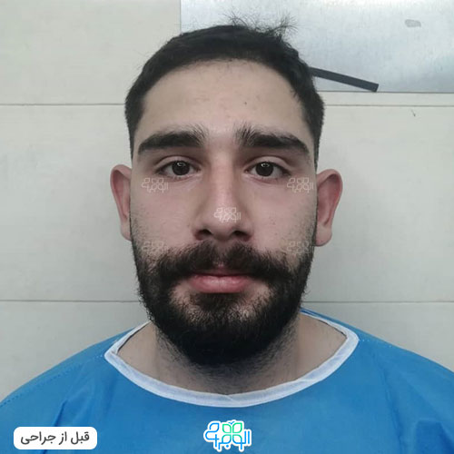 عکس قبل عمل گوش برجسته