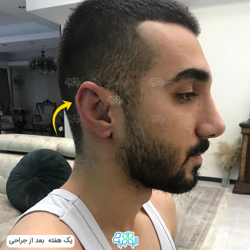 عکس بعد از عمل زیبایی آقایان 1