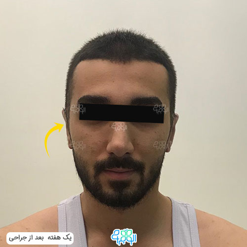 عکس بعد از عمل زیبایی آقایان