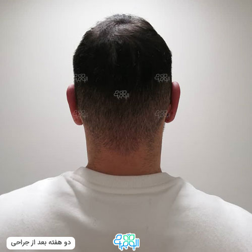 عکس بعد عمل گوش برجسته 2