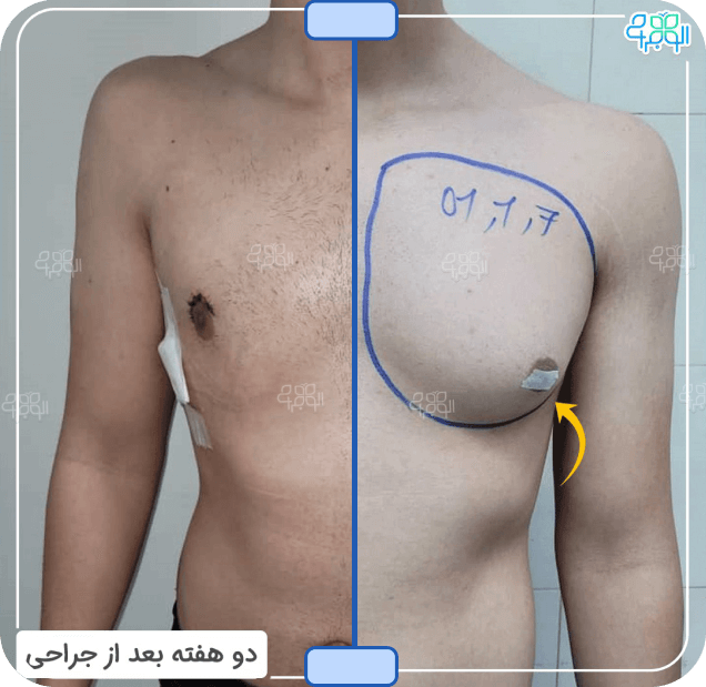 قبل وبعد عمل جراحی ژنیکوماستی 1