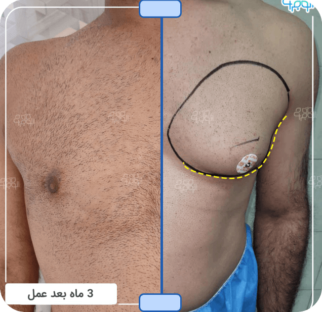 عکس ژنیکوماستی تانر 2