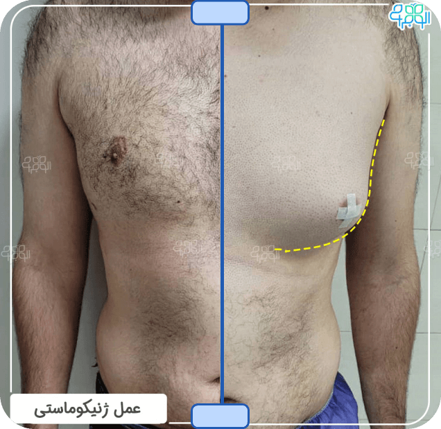 عکس ژنیکوماستی تانر 3