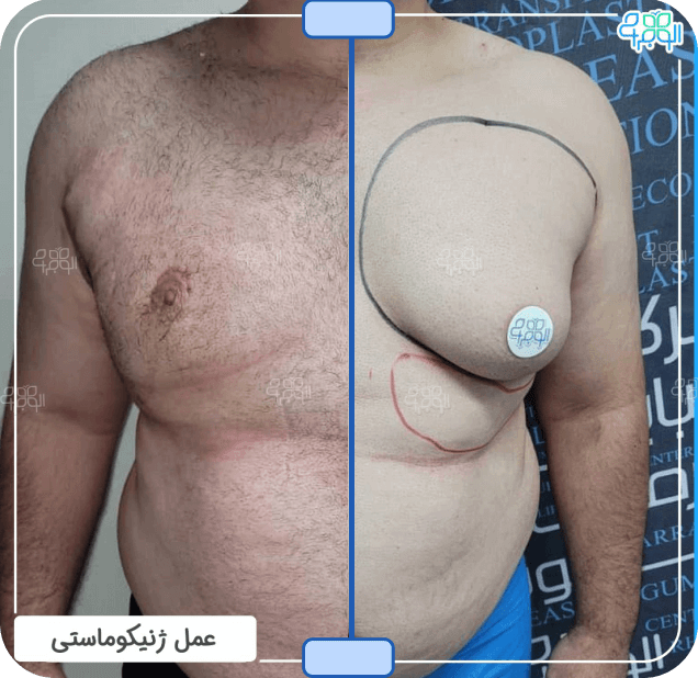 قبل وبعد عمل جراحی ژنیکوماستی 2