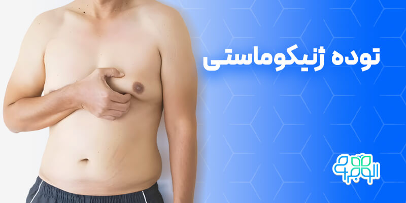 توده ژنیکوماستی