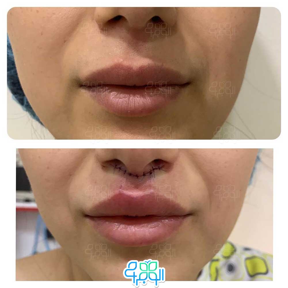 جراحی سانترال لب در الوجراح