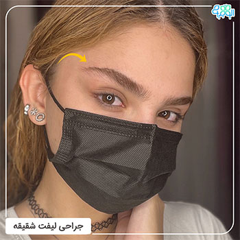 عکس قبل و بعد جراحی لیفت شقیقه 2