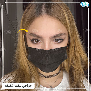 عکس قبل و بعد جراحی لیفت شقیقه