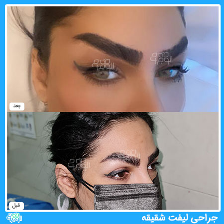 عکس عمل لیفت شقیقه