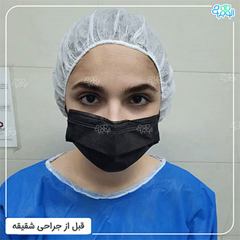 عکس جراحی لیفت شقیقه