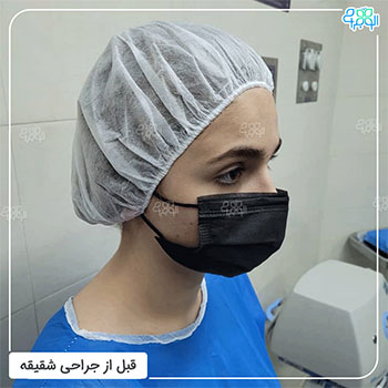 عکس جراحی لیفت شقیقه 2