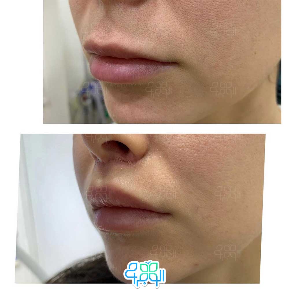 عکس جراحی سانترال لب الو جراح