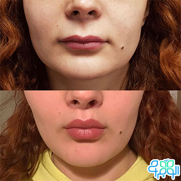 کم کردن فاصله لب و بینی