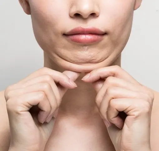 ساکشن غبغب 2