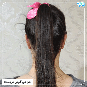 عکس از نمای پشت بعد از عمل اتوپلاستی از نمای پشت سر