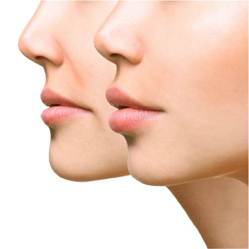 عمل جراحی لیفت سانترال لب