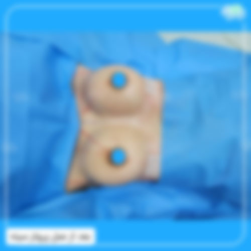 عکس بعد از عمل پروتز سینه