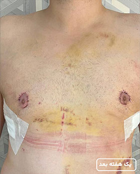 عکس عمل ژنیکوماستی1