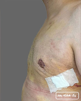 عکس عمل ژنیکوماستی2