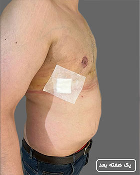 عکس عمل ژنیکوماستی3