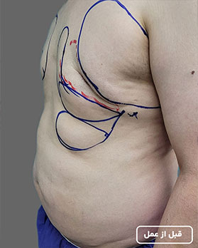 عکس عمل ژنیکوماستی4