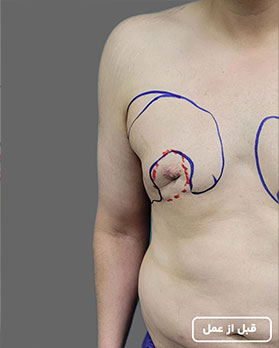 عکس عمل ژنیکوماستی5