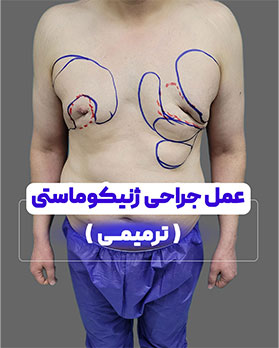 عکس عمل ژنیکوماستی7