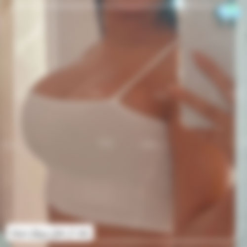 عکس قبل و بعد پروتز سینه1