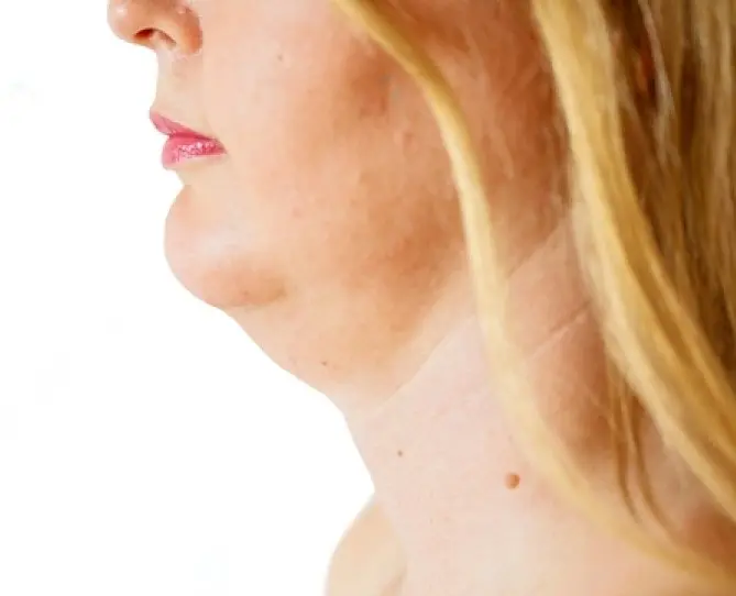 ساکشن غبغب 3