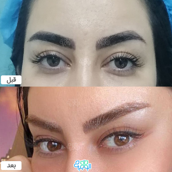 عکس عمل لیفت شقیقه 3