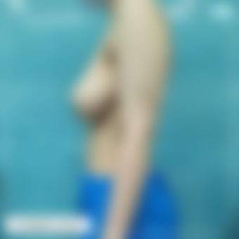 ماموپلاستی عکس 5