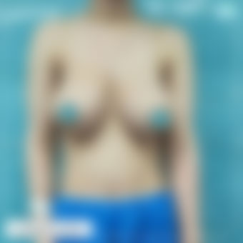 ماموپلاستی عکس 6