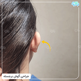 عکس از نمای پشت قبل از عمل اتوپلاستی