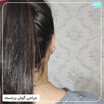 عکس از نمای پشت بعد از پلاستی