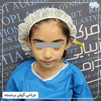 گوش برجسته کودکان 1